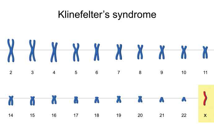 Kielellisen kehityksen puutteet haittaavat Klinefelterin oireyhtymästä kärsiviä poikia