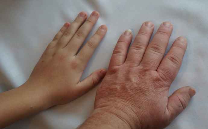 Aivolisäkkeen rauhaskasvain voi aiheuttaa käsien ja jalkojen kasvua vielä aikuisiässä