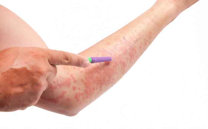 kylmänokkosihottuma