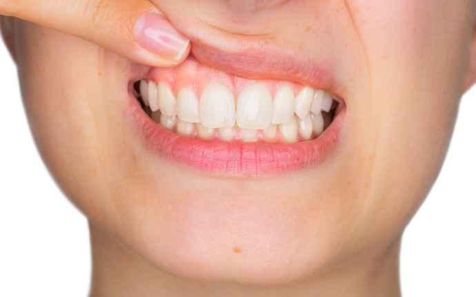 Kolme neljästä suusyövästä voitaisiin ehkäistä – tunnetko riskitekijät?