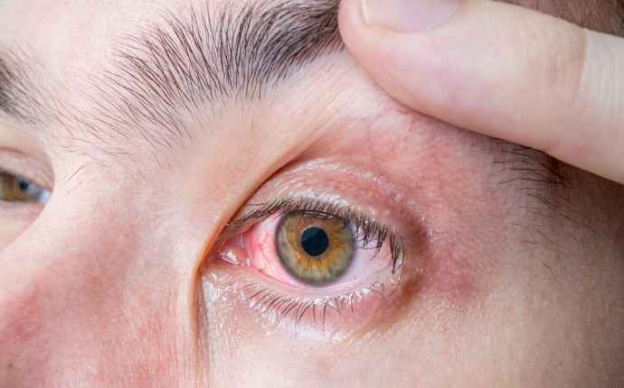 Allerginen silmätulehdus voi helpottaa iän myötä – tipat tehokas hoito 