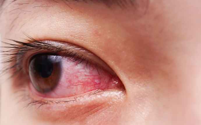 Sarveiskalvotulehdus voi johtaa pahimmillaan sokeutumiseen – näistä merkeistä tunnistat