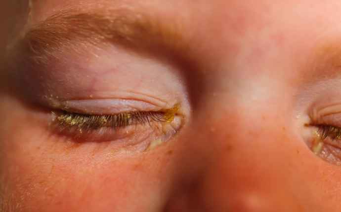 Silmän sidekalvon tulehdus tarttuu helposti – tarvitaanko lääkekuuri?