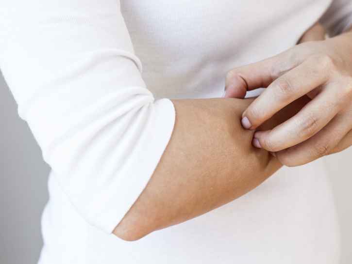 9 helppoa vinkkiä: näin helpotat psoriaasin kutinaa