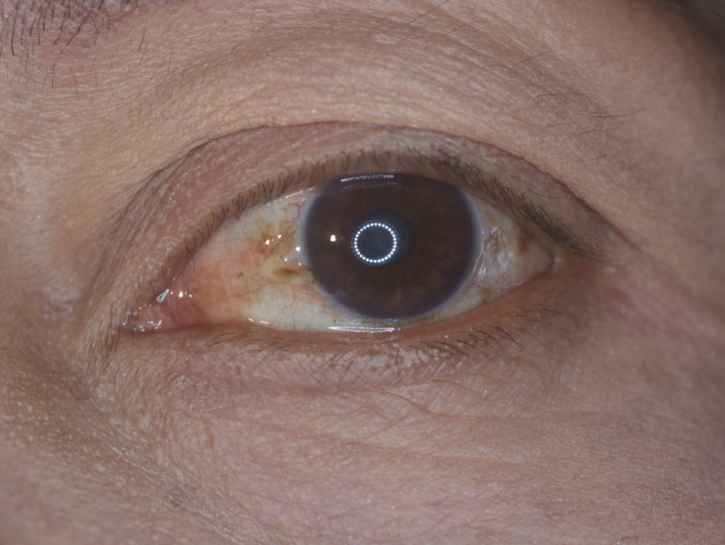 Silmän sidekalvokyhmy on vaaraton kosmeettinen haitta