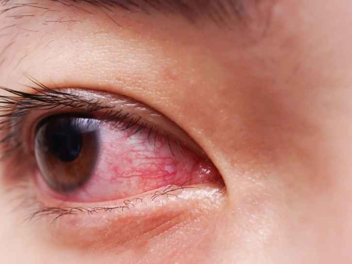 Sarveiskalvotulehdus voi johtaa pahimmillaan sokeutumiseen – näistä merkeistä tunnistat