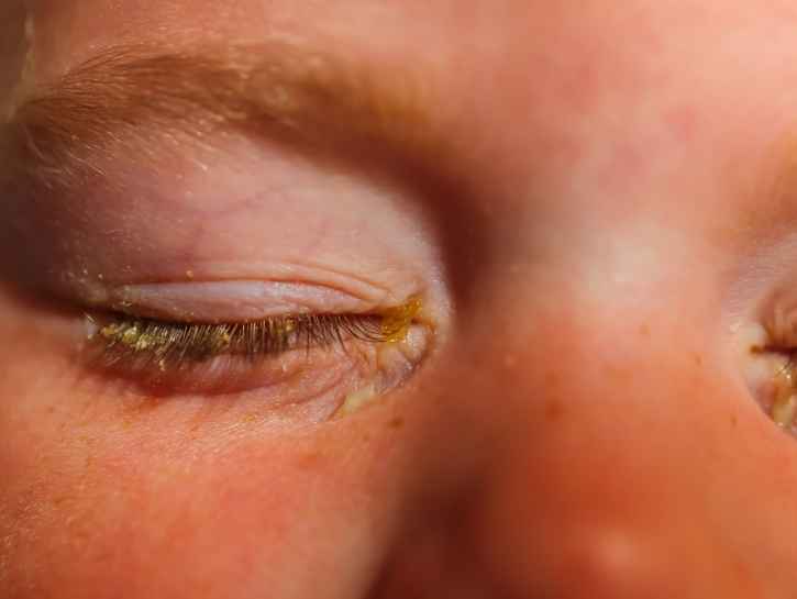 Silmän sidekalvon tulehdus tarttuu helposti – tarvitaanko lääkekuuri?