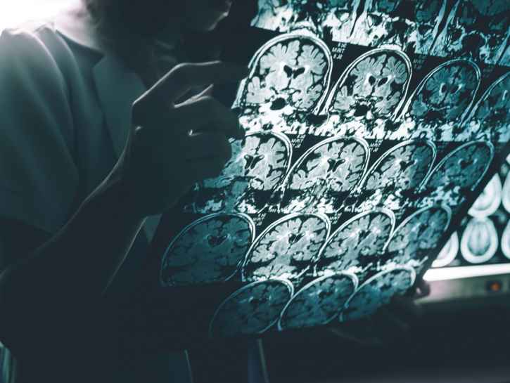 Toivonpilkahduksia ja epäonnistumisia – Alzheimerin taudin lääkekehitys etenee hitaasti