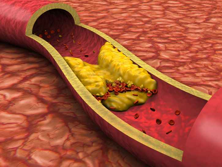 Korkea kolesteroli on oireeton ja siten petollinen