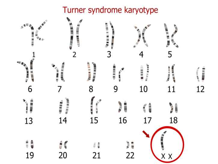 Turnerin oireyhtymä havaitaan usein tytön murrosiän kynnyksellä