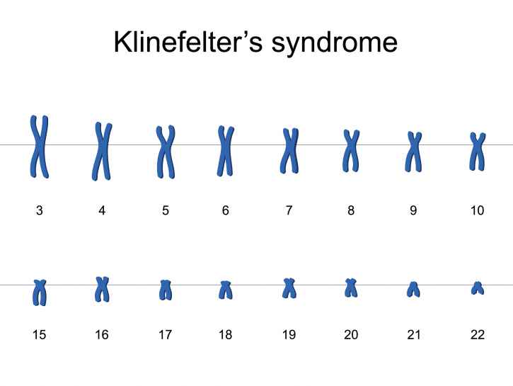 Kielellisen kehityksen puutteet haittaavat Klinefelterin oireyhtymästä kärsiviä poikia