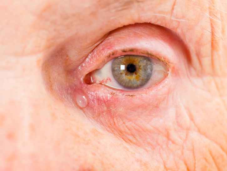 Ärtynyt silmä, huono iho: Levisikö ruusufinni silmään?