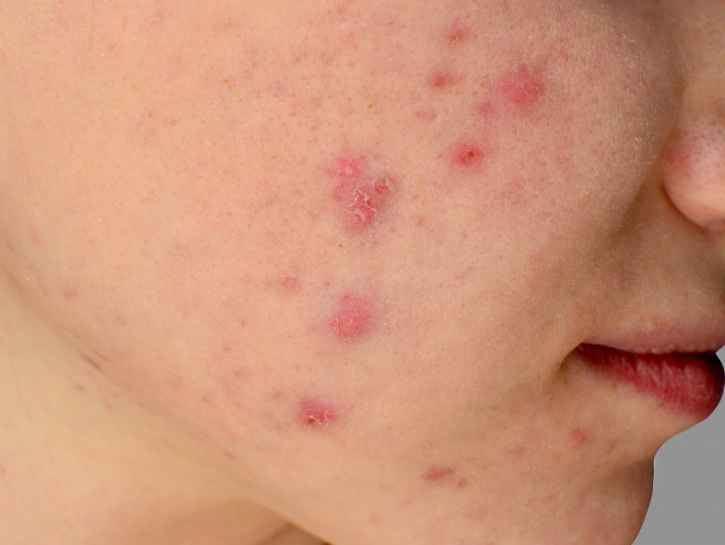 Ruusufinni on hankala ihotulehdus – miten sitä hoidetaan?