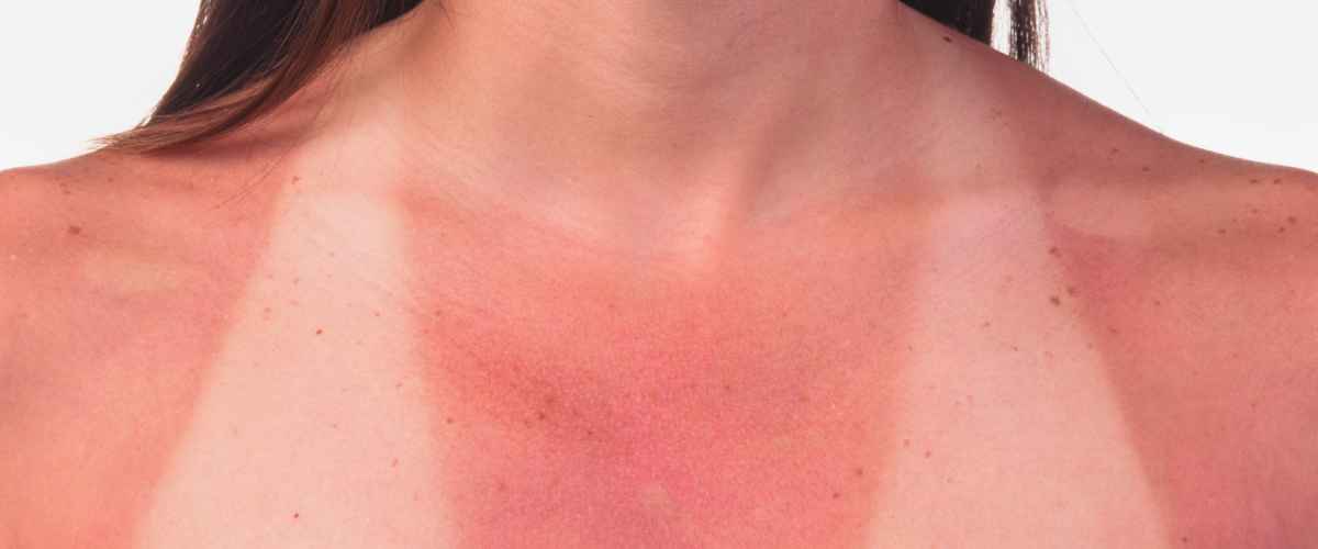 Paloitko auringossa? Näin helpotat oloasi