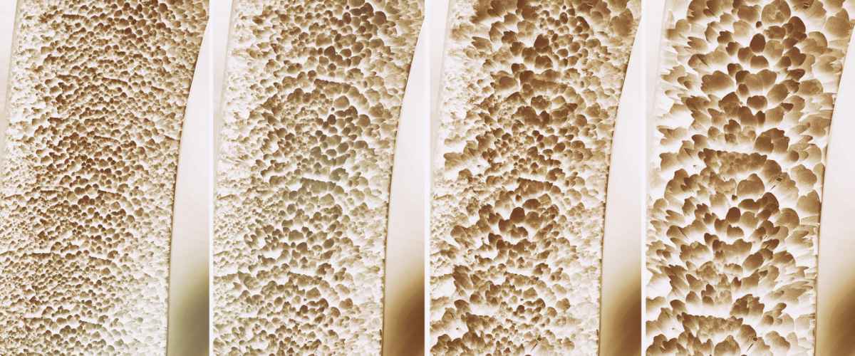 Onko sinulla kortisonilääkitys? Näin voit pienentää osteoporoosin riskiä