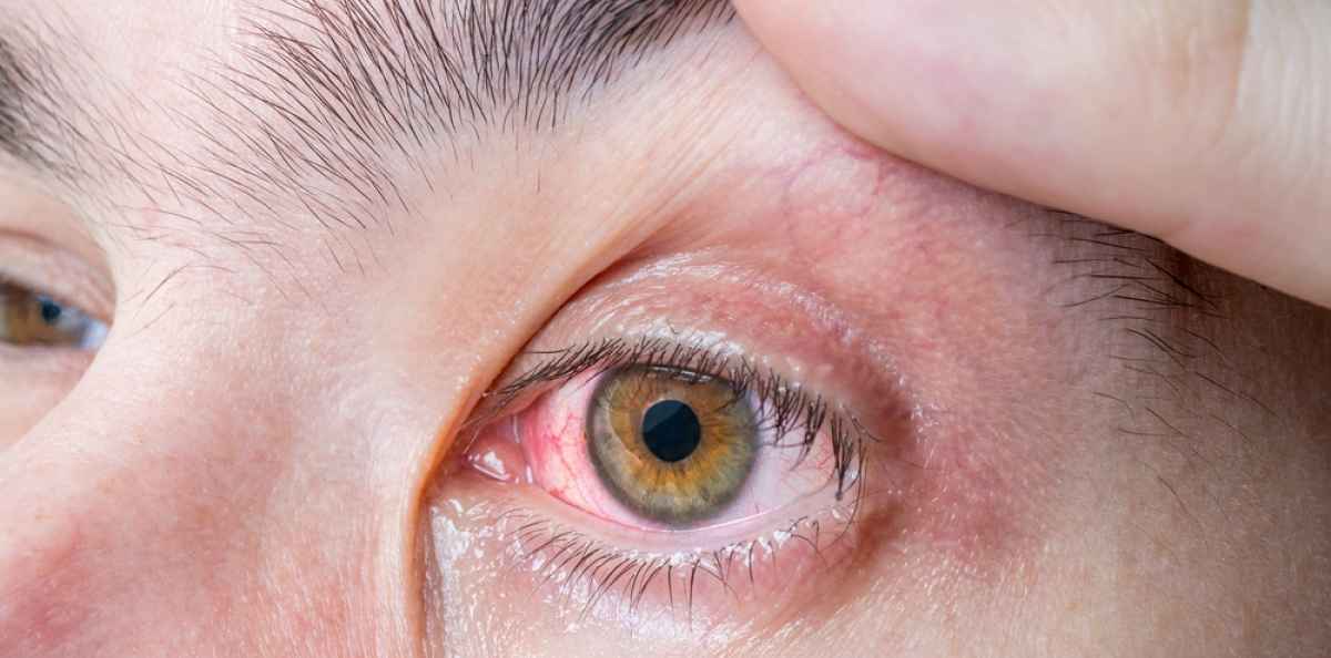Allerginen silmätulehdus voi helpottaa iän myötä – tipat tehokas hoito 