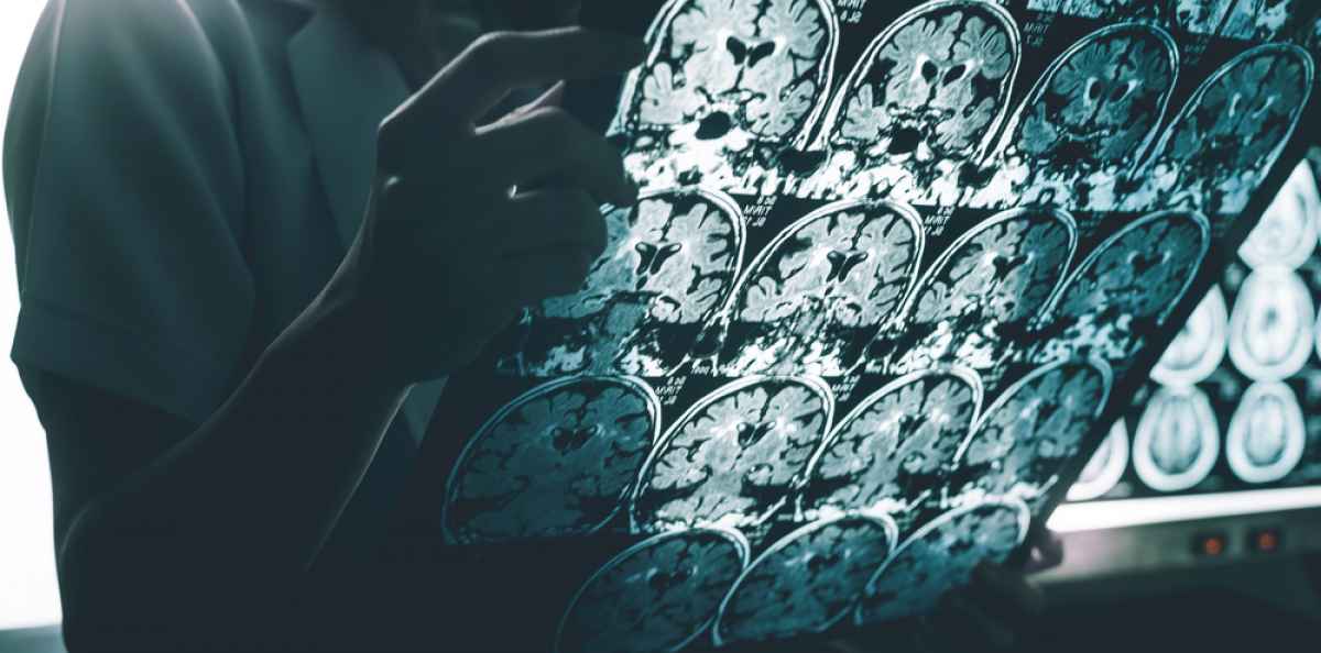 Toivonpilkahduksia ja epäonnistumisia – Alzheimerin taudin lääkekehitys etenee hitaasti