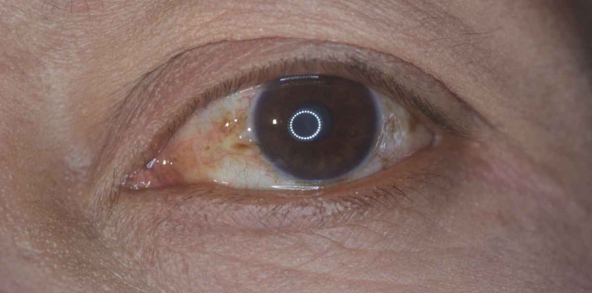 Silmän sidekalvokyhmy on vaaraton kosmeettinen haitta