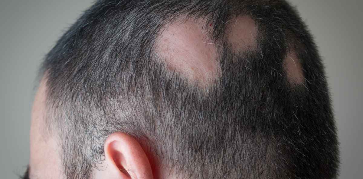 Pälvikalju saa hiukset irtoamaan läiskittäin – syytä ei tunneta