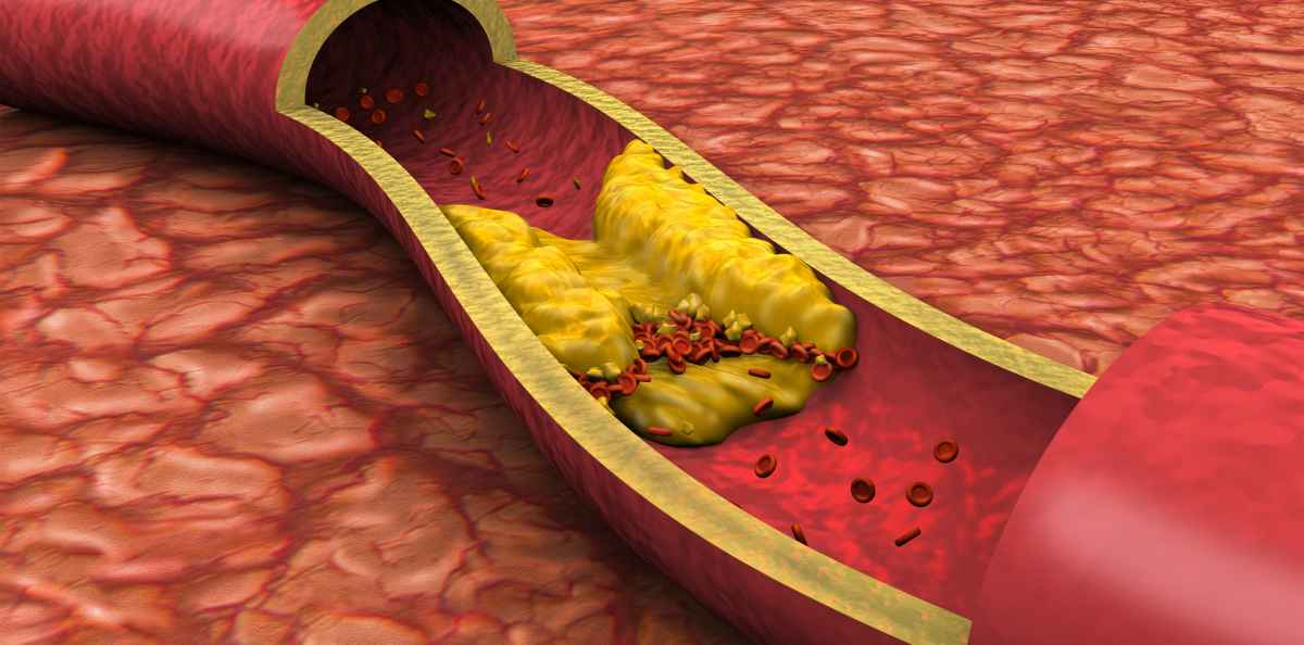 Korkea kolesteroli on oireeton ja siten petollinen