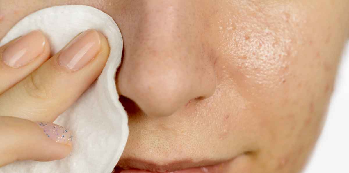 Aknea on useampaa tyyppiä – löydä sopiva hoito omiin iho-ongelmiisi