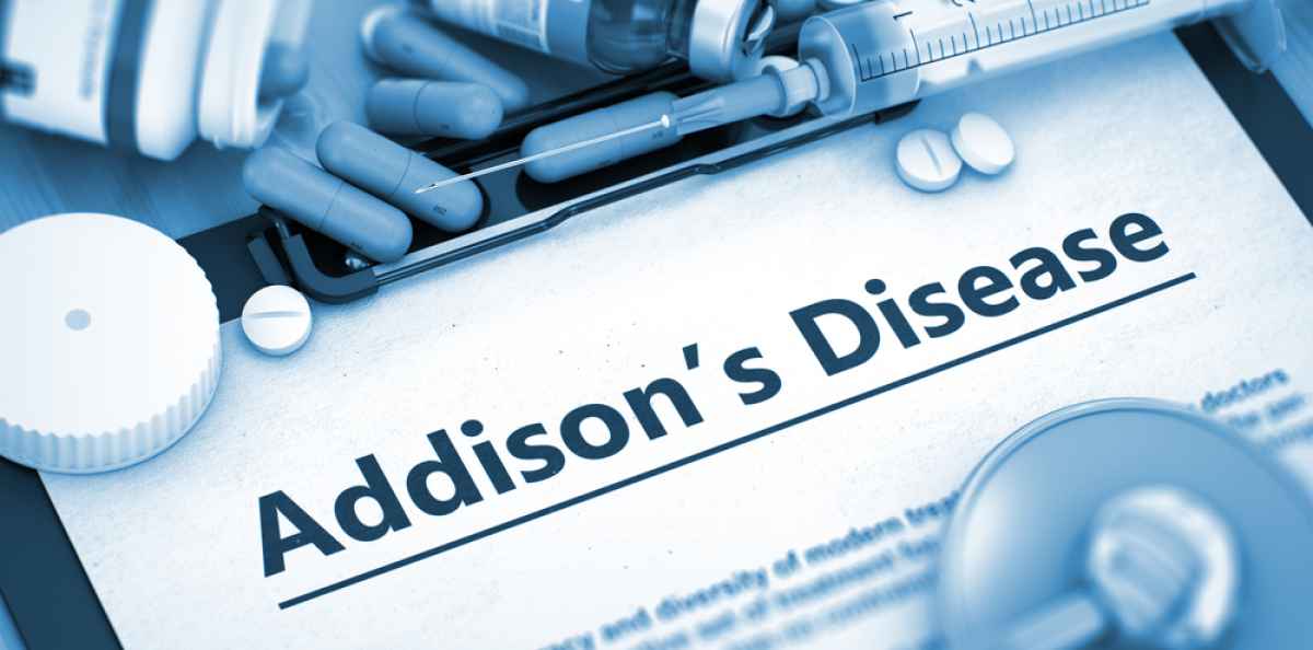 Addisonin tauti puhkeaa pääosin autoimmuunireaktion seurauksena