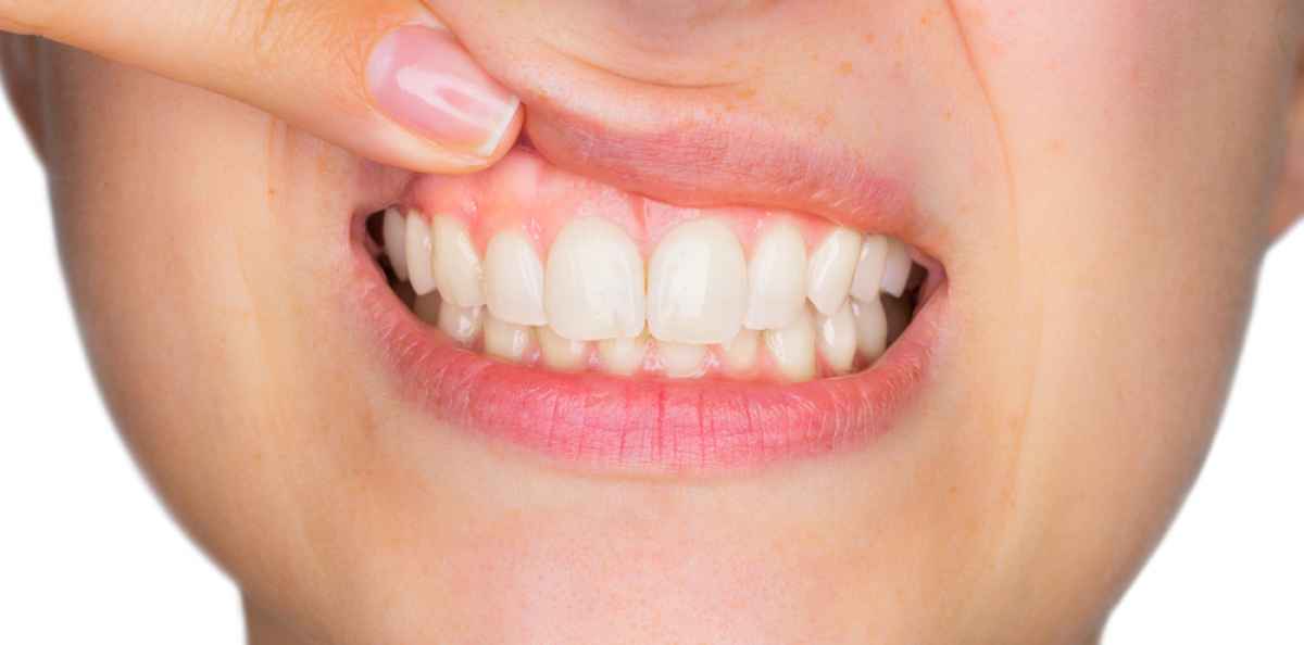 Kolme neljästä suusyövästä voitaisiin ehkäistä – tunnetko riskitekijät?